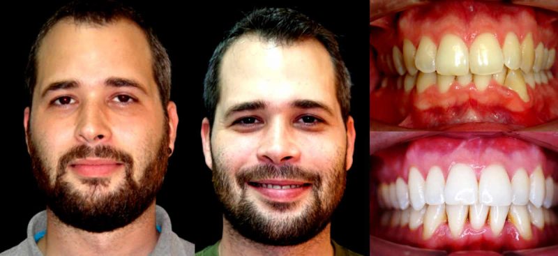 antes y después apnea del sueño