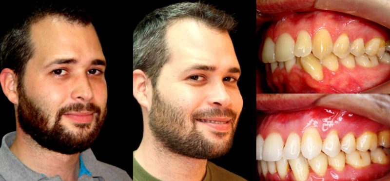 antes y después apnea del sueño