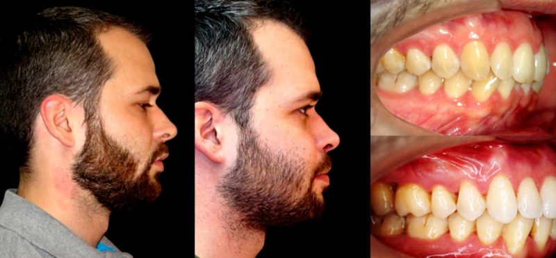 antes y después apnea del sueño