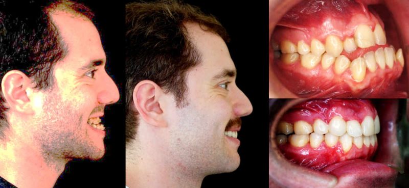 antes y después apnea del sueño