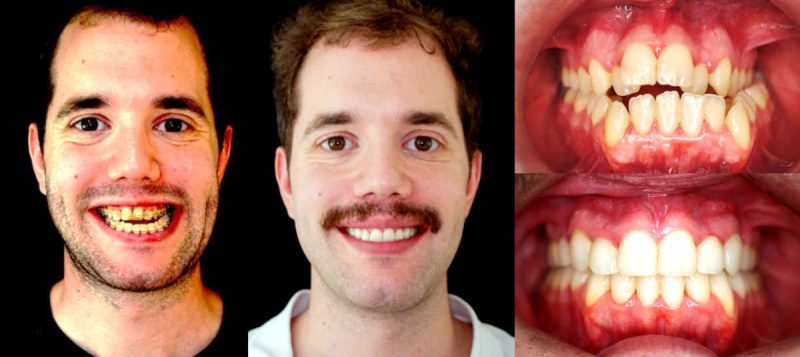 antes y después apnea del sueño