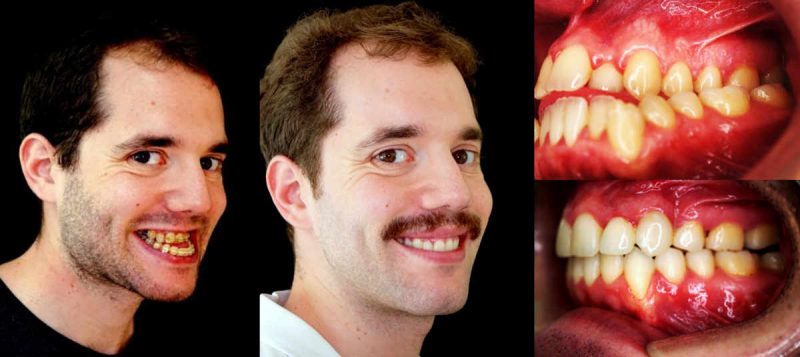 antes y después apnea del sueño